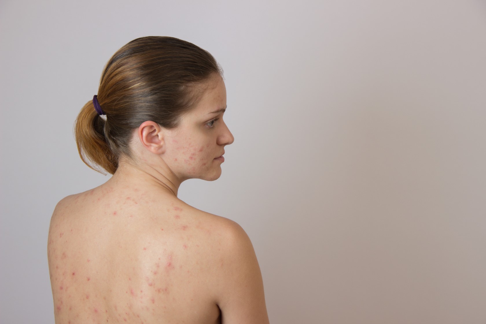 4 Solutions for Hormonal Acne That Really Work